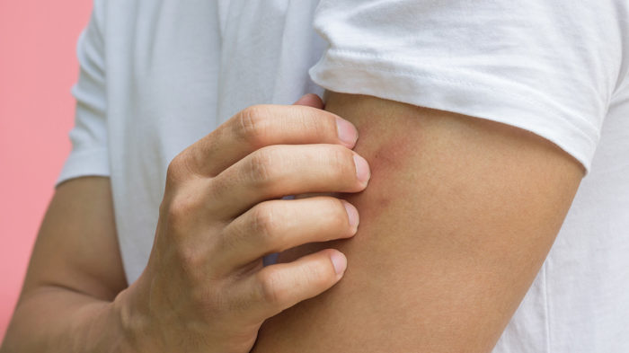 imagen destacada Qué es la Dermatitis Atópica