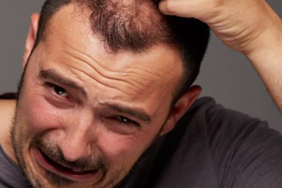 ALOPECIA ANDROGENÉTICA