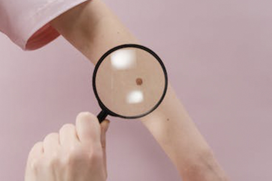 NEVUS MELANOCÍTICOS Y MELANOMA