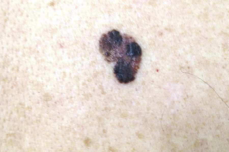 MELANOMA MALIGNO