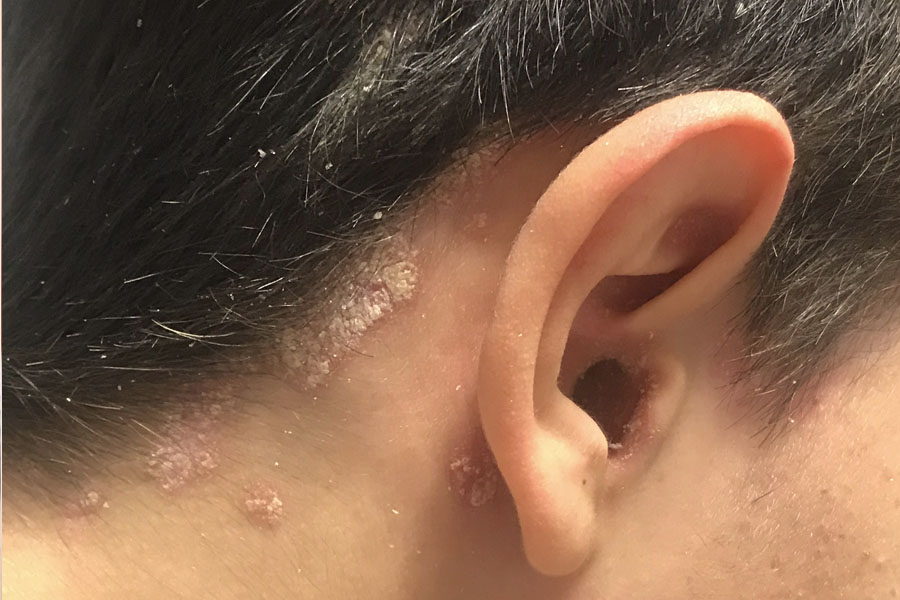 PSORIASIS