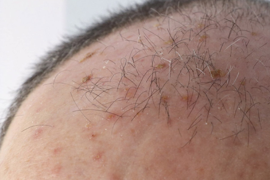 QUERATOSIS ACTÍNICAS